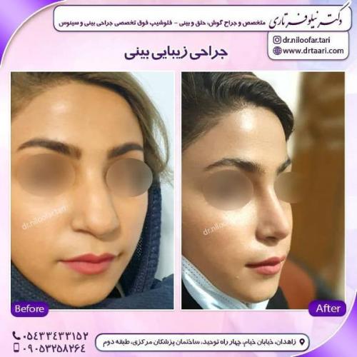 جراحی بینی 285 (42)