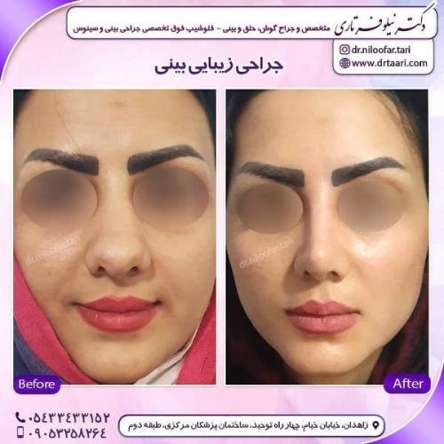جراحی بینی 285 (44)