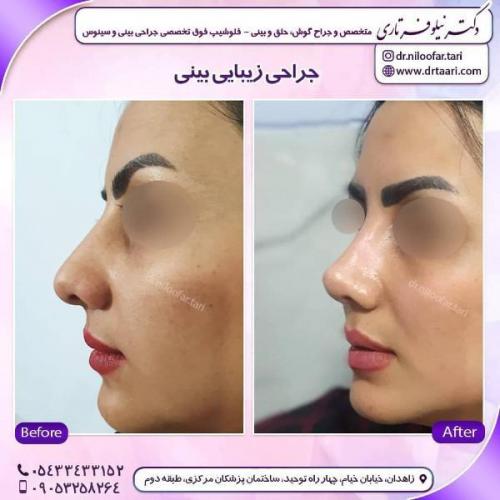 جراحی بینی 285 (46)