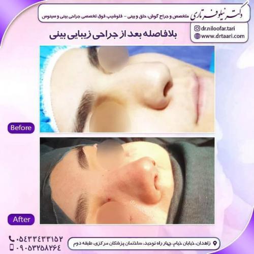 جراحی بینی 285 (48)