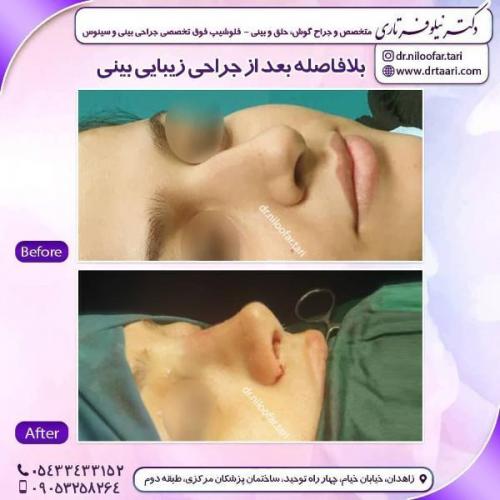 جراحی بینی 285 (5)