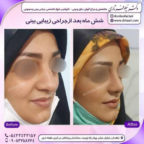 جراحی بینی 285 (50)