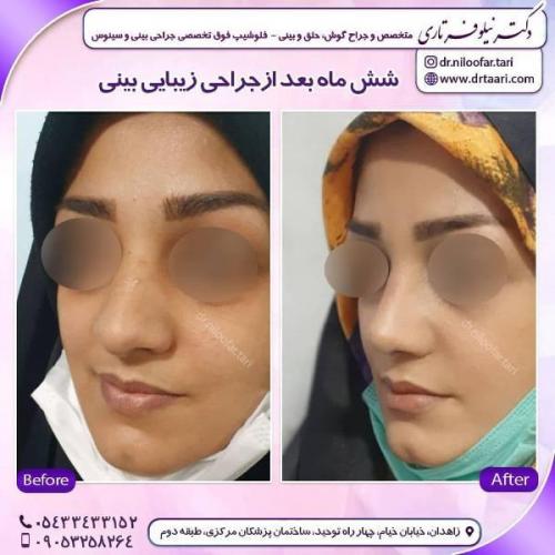 جراحی بینی 285 (51)