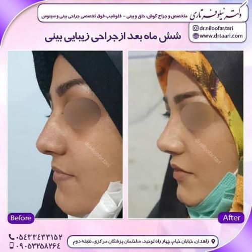 جراحی بینی 285 (52)