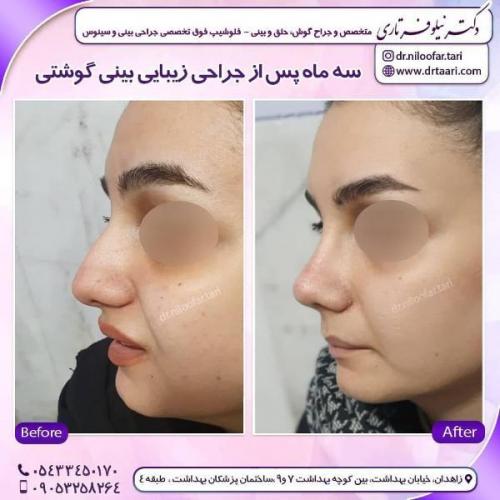 جراحی بینی 285 (55)