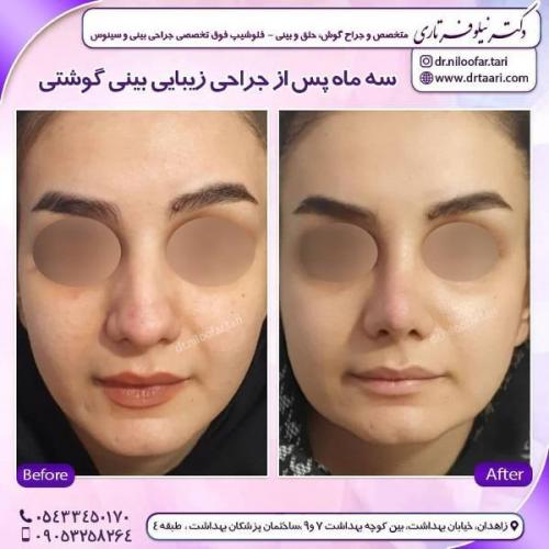 جراحی بینی 285 (56)