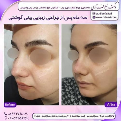 جراحی بینی 285 (57)