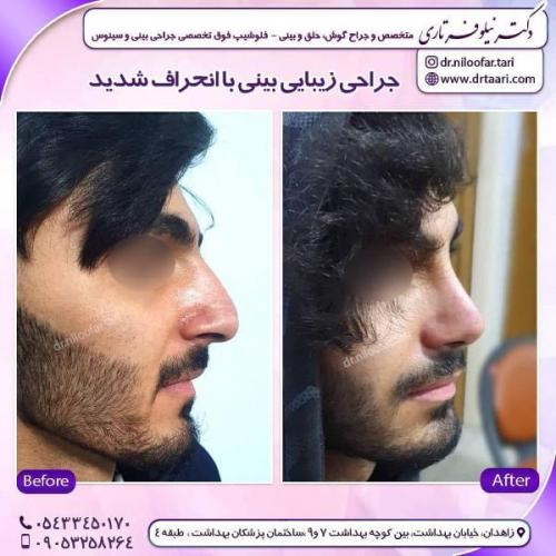 جراحی بینی 285 (60)