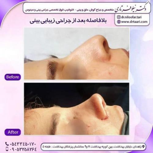 جراحی بینی 285 (61)