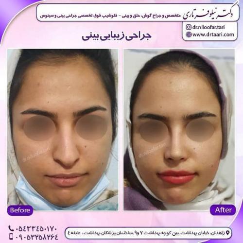 جراحی بینی 285 (63)