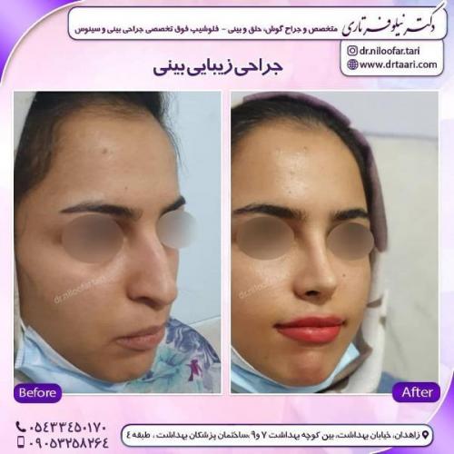 جراحی بینی 285 (64)