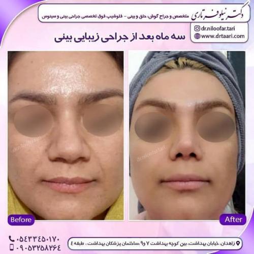 جراحی بینی 285 (69)