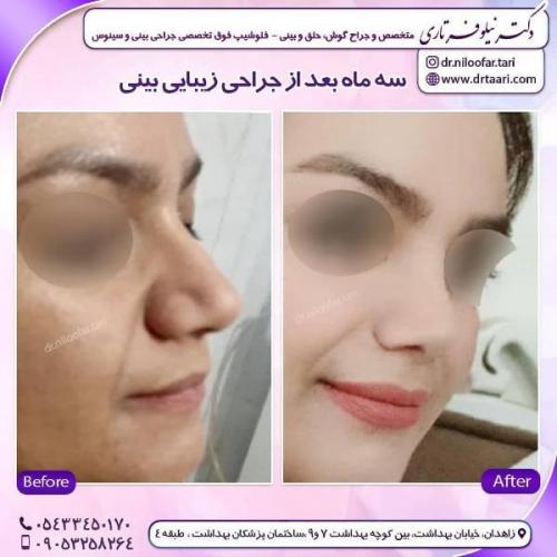 جراحی بینی 285 (70)