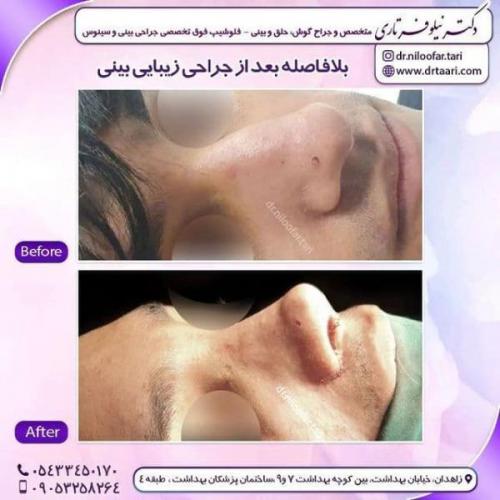 جراحی بینی 285 (71)