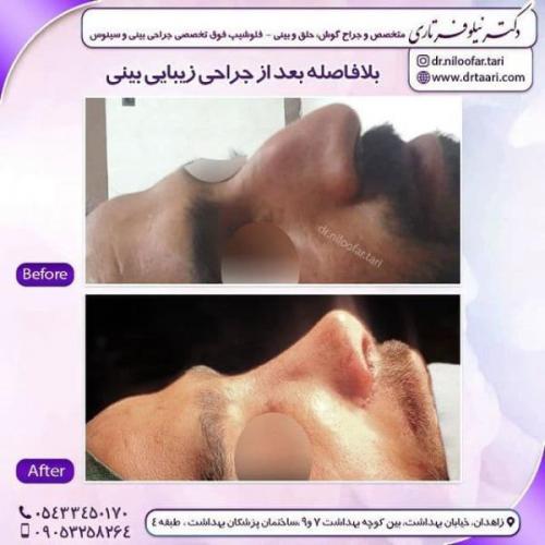 جراحی بینی 285 (74)