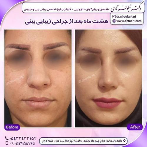 جراحی بینی 285 (8)