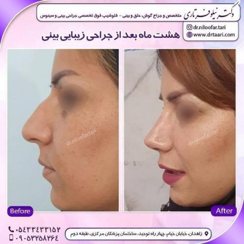 جراحی بینی 285 (9)