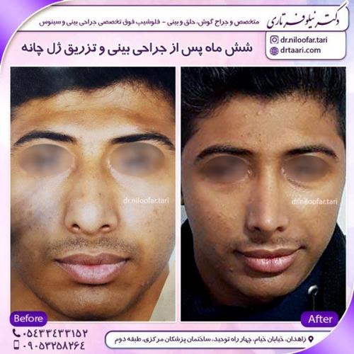 جراحی بینی 4