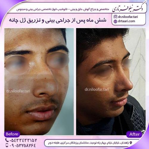 جراحی بینی 6