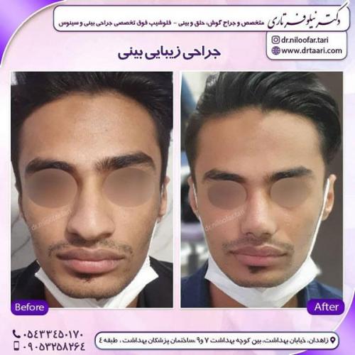 جراحی بینی در زاهدان 1