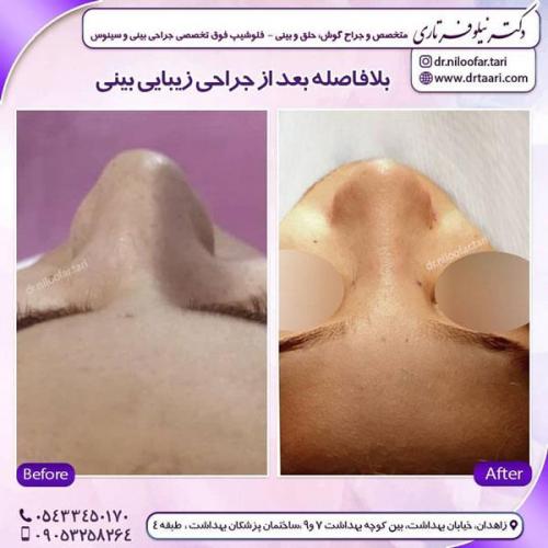 جراحی بینی در زاهدان 10