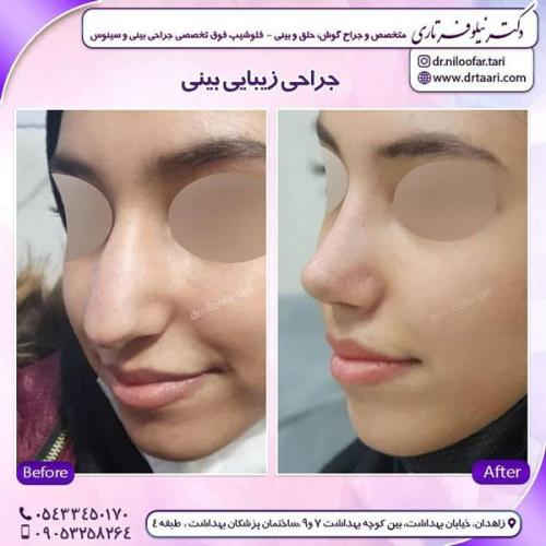 جراحی بینی در زاهدان 11
