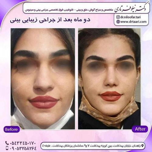 جراحی بینی در زاهدان 12