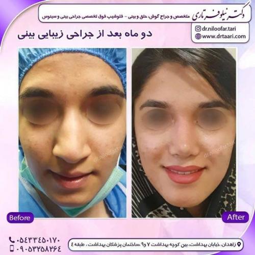 جراحی بینی در زاهدان 14