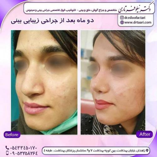 جراحی بینی در زاهدان 15