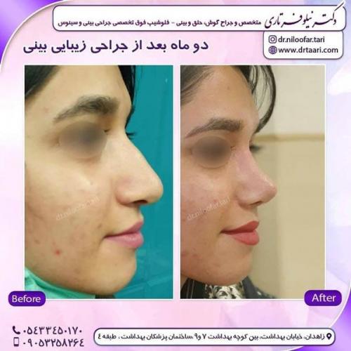 جراحی بینی در زاهدان 16