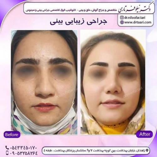 جراحی بینی در زاهدان 17