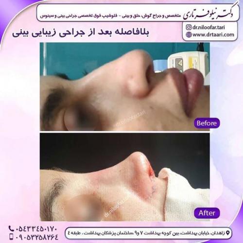 جراحی بینی در زاهدان 19