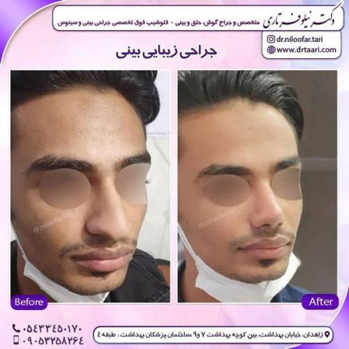 جراحی بینی در زاهدان 2