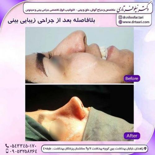 جراحی بینی در زاهدان 20