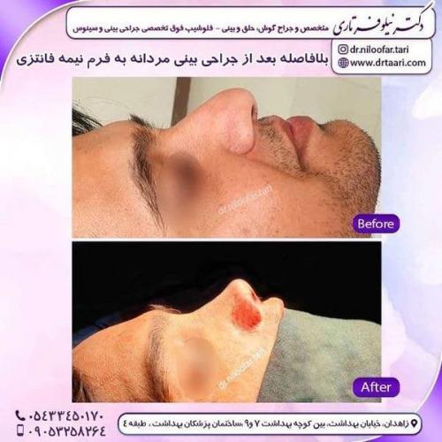جراحی بینی در زاهدان 21