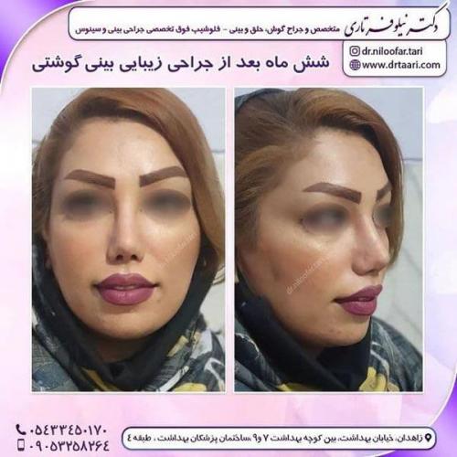 جراحی بینی در زاهدان 22