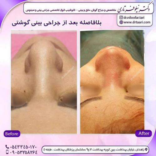 جراحی بینی در زاهدان 24