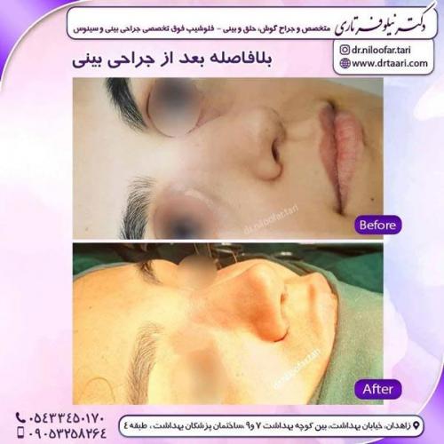جراحی بینی در زاهدان 25