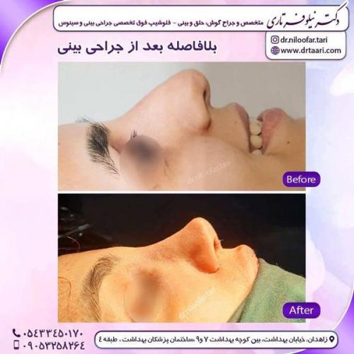 جراحی بینی در زاهدان 26