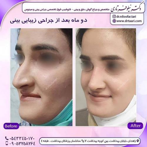 جراحی بینی در زاهدان 27