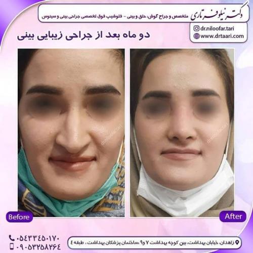 جراحی بینی در زاهدان 28