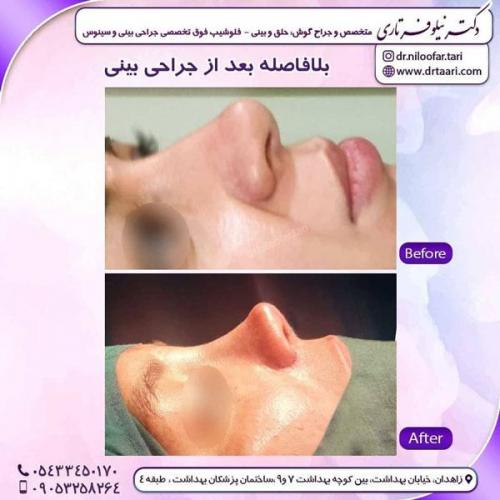 جراحی بینی در زاهدان 29