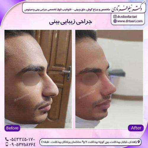 جراحی بینی در زاهدان 3