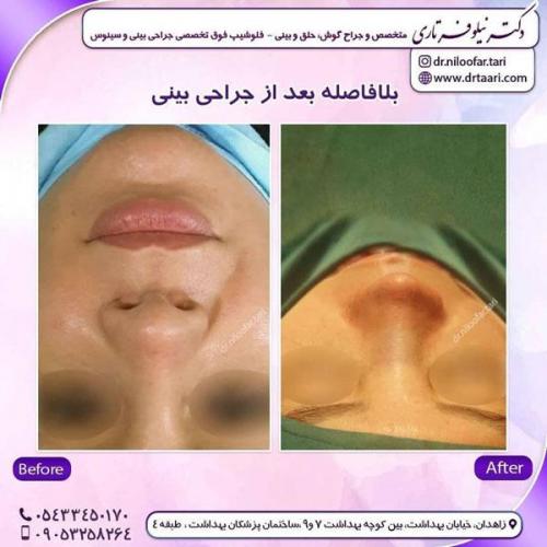 جراحی بینی در زاهدان 30