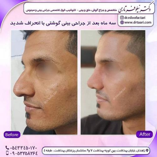 جراحی بینی در زاهدان 31