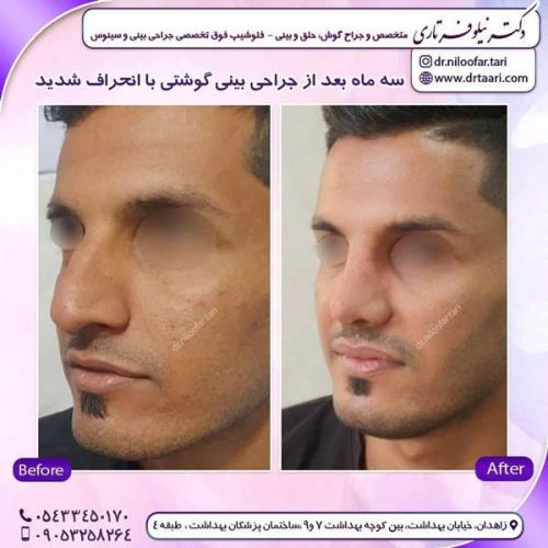 جراحی بینی در زاهدان 32