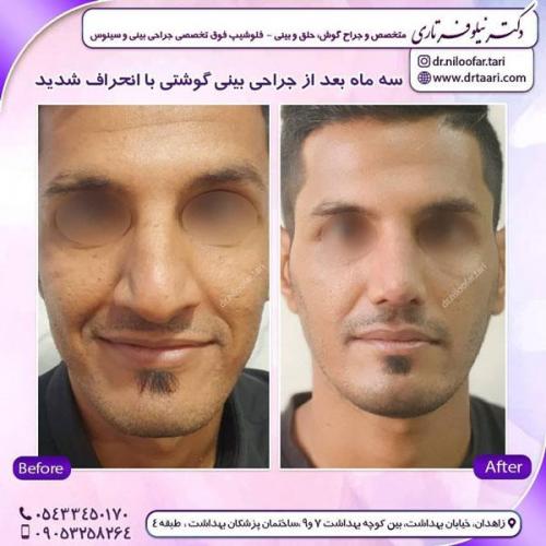جراحی بینی در زاهدان 33