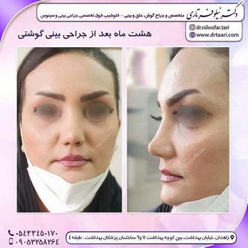 جراحی بینی در زاهدان 34