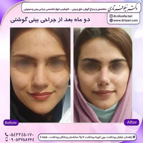 جراحی بینی در زاهدان 35
