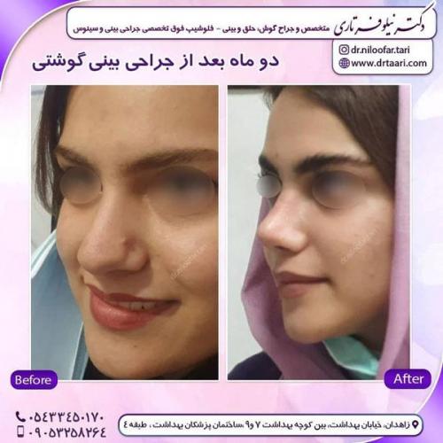 جراحی بینی در زاهدان 36
